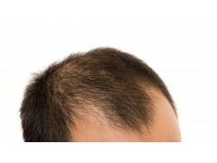 什么是溢脂性脱发？有什么症状特点？